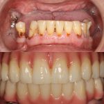 elevación seno maxilar