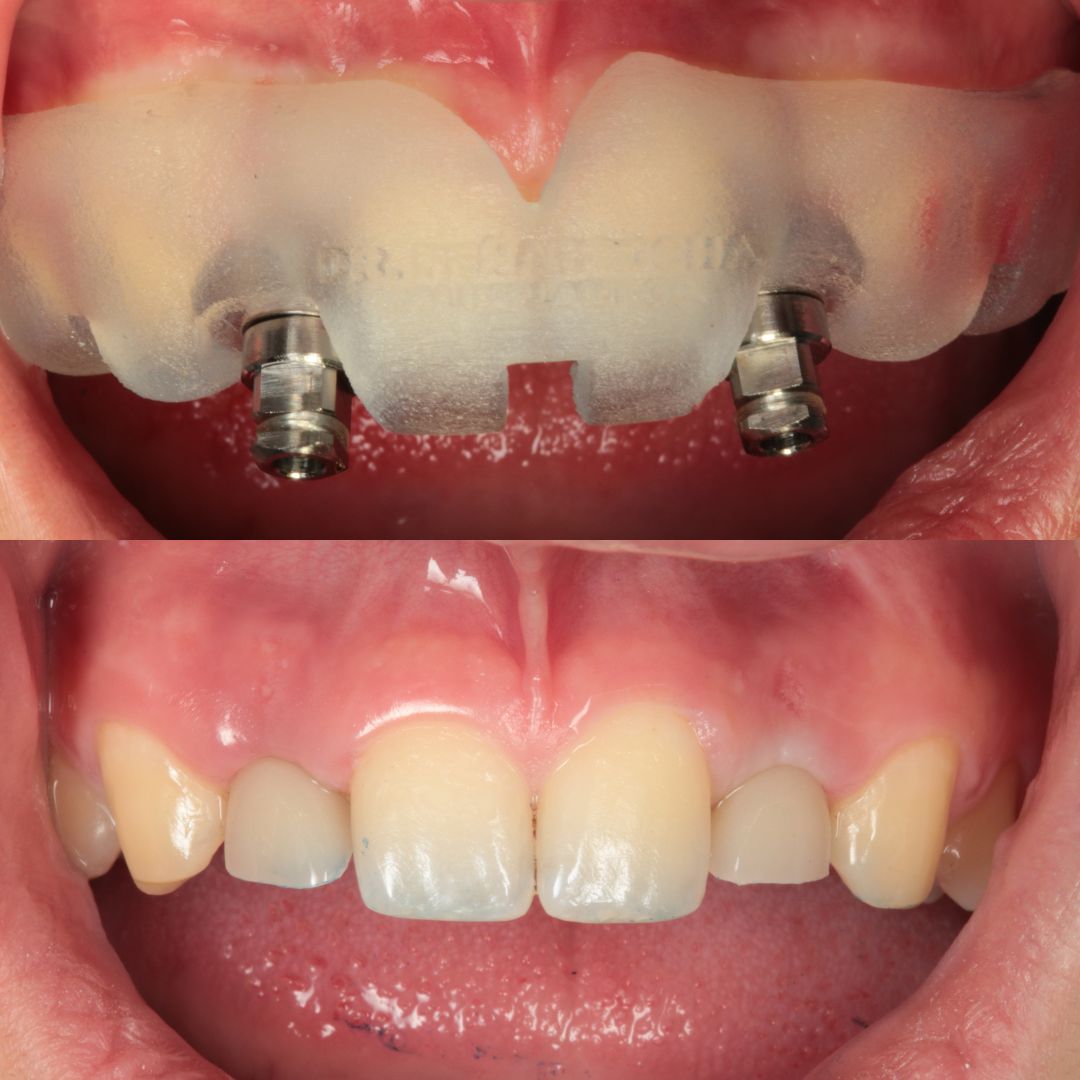 implantes dentales caso clinico