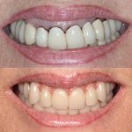 implantes inclinados caso