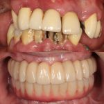 protesis fijas sobre implantes dentales